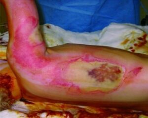 Microdactaly SURGERY PICTURES – Oretha Academy